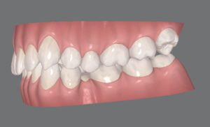 従来のインビザライン画像